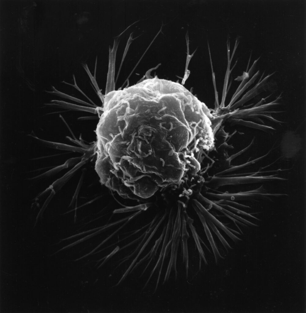 AI Model Predicts Cancer Survival Using Patient Photos, Study Finds